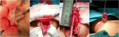 Reoperation frequency after transverse preputial Island flap urethroplasty “Duckett’s technique” in treatment of severe hypospadias: A single center study